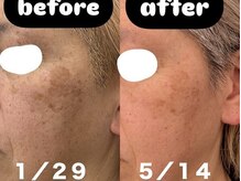 ビーアヴニール(B.Avenir)/シミくすみケア