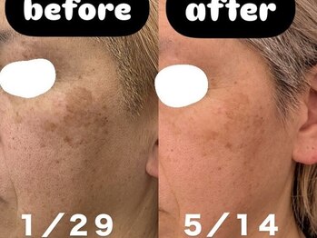 ビーアヴニール(B.Avenir)/シミくすみケア