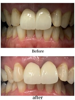 ふわり 別府店(FUWARI)/【セルフホワイトニング】