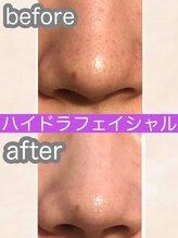 ヘッドミント 福井店/ハイドロフェイシャル