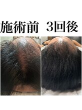 キュライム 熊本(CURAIM)/育毛促進　【60代男性】