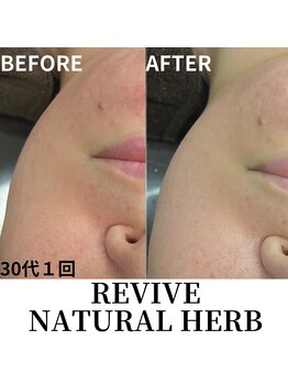 プレイス 太融寺店(PLACE)/剥離しないハーブピーリング