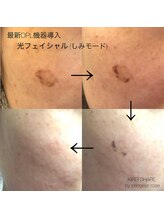 プリンセスローズ 焼津店(Princess Rose)/光フェイシャル