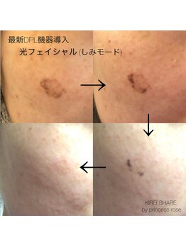 プリンセスローズ 焼津店(Princess Rose)/光フェイシャル