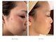 ラシェ プリズ 心斎橋の写真/【シミ改善実績No.1】創業25年の信頼。本気で悩む大人女性が最後に辿り着く、本格シミケア専門店