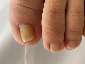 フットメンテ 巻き爪矯正センター 南浦和/巻き爪　上面