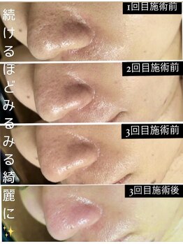 ソウ 新宿(SOU)/大人気毛穴エクストラクション☆