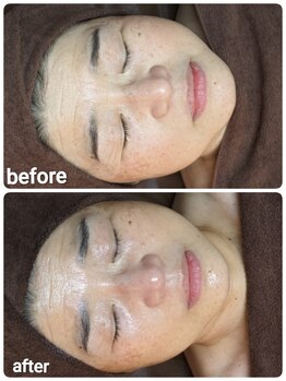 ウララ(ulala)/ララ1回目のビフォーアフター