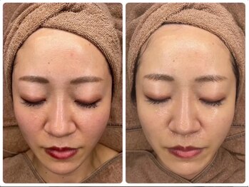 ホワイトアクア 京都店(WHITE AQUA)/ララピール/毛穴/京都