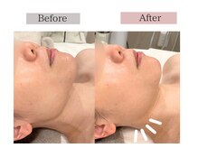 フロリール アザブジュウバン(FlorirAzabujuban)/慢性的な食いしばり・エラ張り