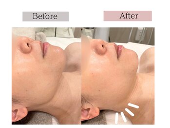 フロリール アザブジュウバン(FlorirAzabujuban)/慢性的な食いしばり・エラ張り