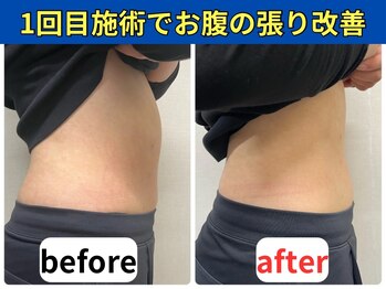 リポール 目黒(Re pol)/BeforeAfter 腸もみオイルコース