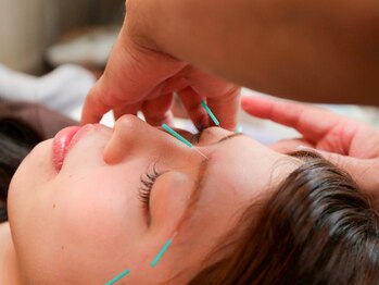 ながたともひさ指圧はり灸治療院/美容鍼の施術で小顔効果