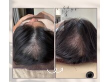 リズ ボーテ/頭皮棘ハーブピーリング