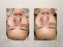 アバンダンティア 姫路店/点在するシミを一つ一つ排出