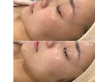 エトレ(etre)の雰囲気(根本改善プログラム+強炭酸で毛穴肌荒れを鎮静揺らがない肌作り)