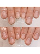 エッセンス (Essence)/乾燥による角質化,爪トラブル