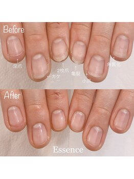 エッセンス (Essence)/乾燥による角質化,爪トラブル