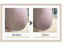 巻き爪補正店 錦糸町店/【トータルフットケア】