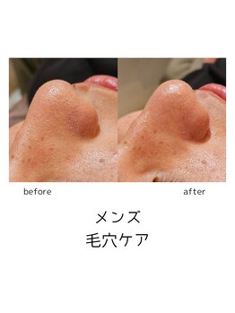 ウル バイ ラシック(Ulu by Lasic)/【毛穴吸引】皮脂詰まり改善◎