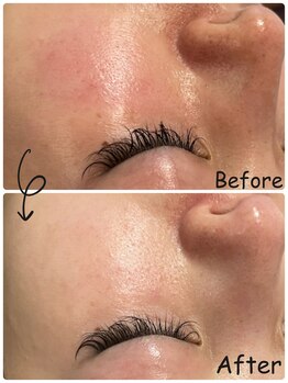 バブルビューティー(Bubble beauty)/ララピール・LDM・LED