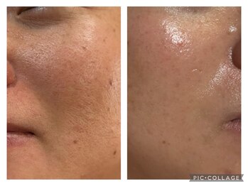 ザ ワン(THE ONE)/植物幹細胞導入