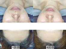 和歌山ララピール&韓国肌管理専門店/ララピール【艶肌/美白/くすみ】