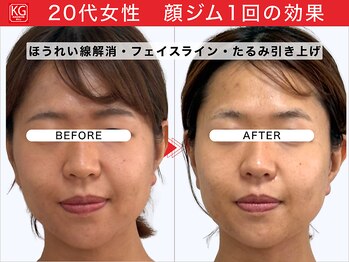 顔ジム 麻布店/20代女性顔ジム1回の効果