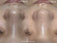 ナチュールムーン(Nature moon.)/毛穴洗浄