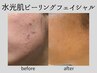 【ニキビ・揺らぎ肌】繰り返すニキビ・赤みを鎮静。水光肌ピーリング¥16000⇒