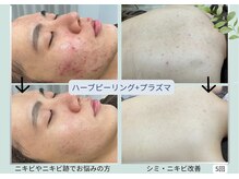 ウェルビー(Well-Be)の雰囲気（ハーフピーリング＋プラズマで驚きの変化！）