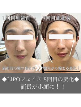 ナンバーファイブクリニカルサロン 札幌店(No.5)/BeforeAfter/小顔&面長改善