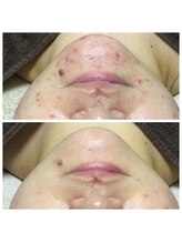 リラーナ(Re rana)/アゴニキビケア♪