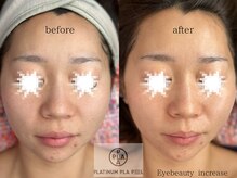 アイ ビューティー インクリース 岸和田店(Eye beauty increase)/プラチナピーリング