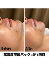 Sスタイルスタジオ 福岡天神/炭酸パック×サーマル1回目