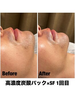 Sスタイルスタジオ 福岡天神/炭酸パック×サーマル1回目