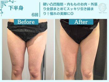 フローフシ∞/【痩身】下半身・お尻の脂肪撃退