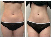 ジュエル(JEWELL)の雰囲気（【脂肪冷却モニター様】美しく整う上質なくびれラインへ）