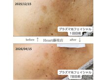 ハート 藤枝店(Heart)の雰囲気(大人気フォト光フェイシャルでシミ改善・リフトアップ!透明感◎)