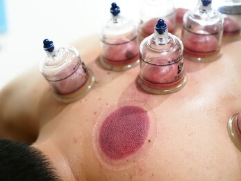 りっつ鍼灸院/カッピング背中