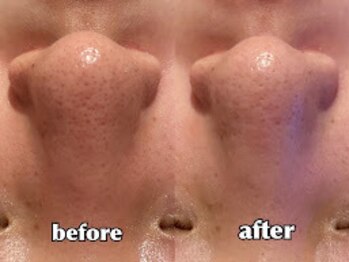 エステティックサロン フェアリー(ESTHETIC SALON FAIRLY)/ハイドロ/Before→After