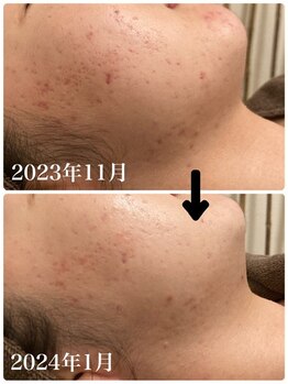 ヴィヴフォー(VIV for)/ニキビケアに。