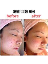 縁 整体院(en)/ハーブピーリング