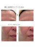 【たるみ・小ジワ改善】ピーリング×高濃度ヒト幹細胞導入15,000円→