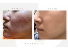 エムアイ 六本木(Mi)/ハーブピーリング