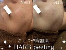 グランクウォーレ(Gran Cuore)/剥離なしで優しく肌質改善！