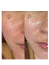 ユズドット(yuzu.)/安定人気ハーブピーリング