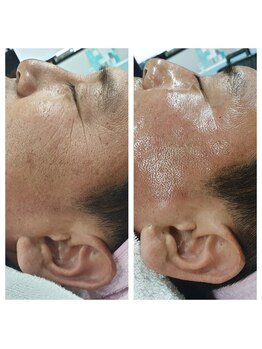 ビューティーリバース FORMEN 東戸塚店/話題の韓国肌管理 ララピール