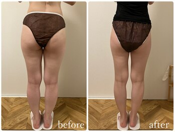 リリィブラン(Lily branc)/痩身/ヒップ+太もも集中