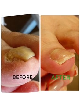 フットスタジオ アルク(FOOT STUDIO ALUK)/【肥厚爪のリストアケア】